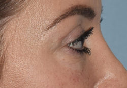 Upper Eyelid Blepharoplasty