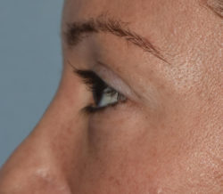 Upper Eyelid Blepharoplasty