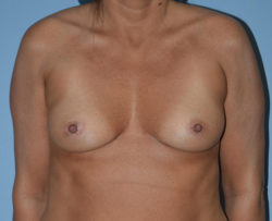 Breast Augmentation