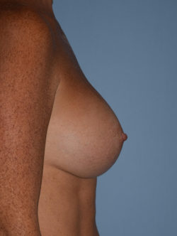 Breast Augmentation