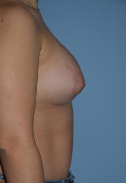 Breast Augmentation