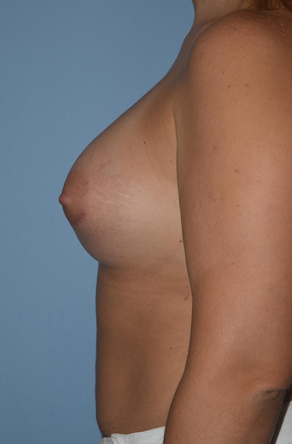 Breast Augmentation