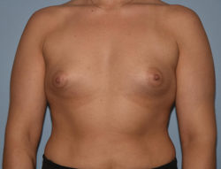 Breast Augmentation