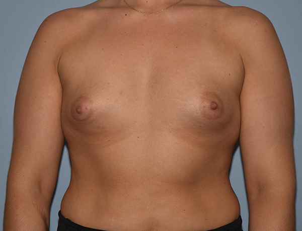Breast Augmentation Case 1085 Before Photo Breast Augmentation