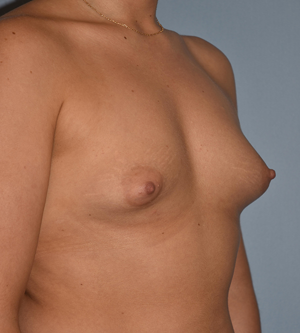 Breast Augmentation