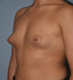 Breast Augmentation