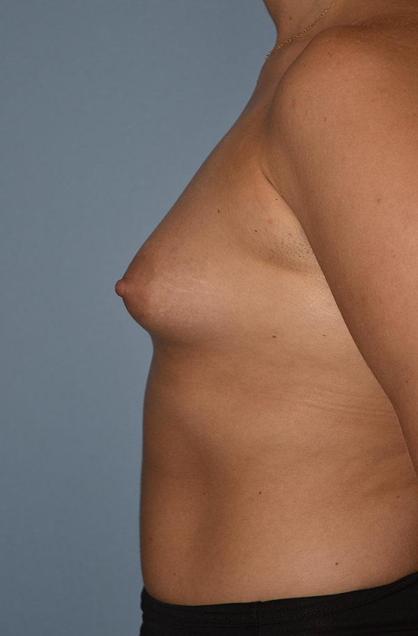 Breast Augmentation