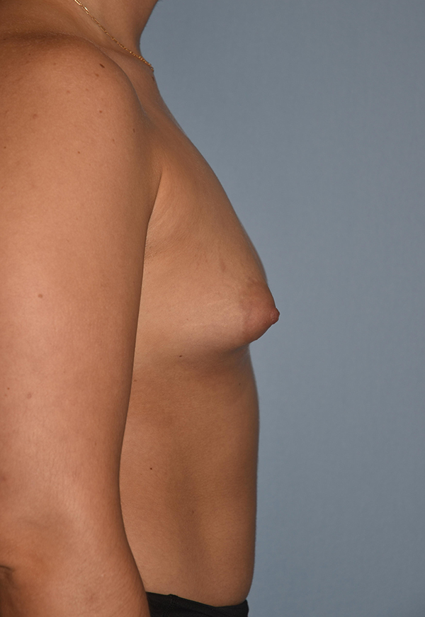 Breast Augmentation