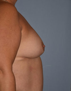 Breast Reduction