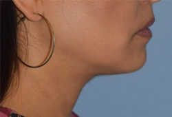 Double Chin Correction