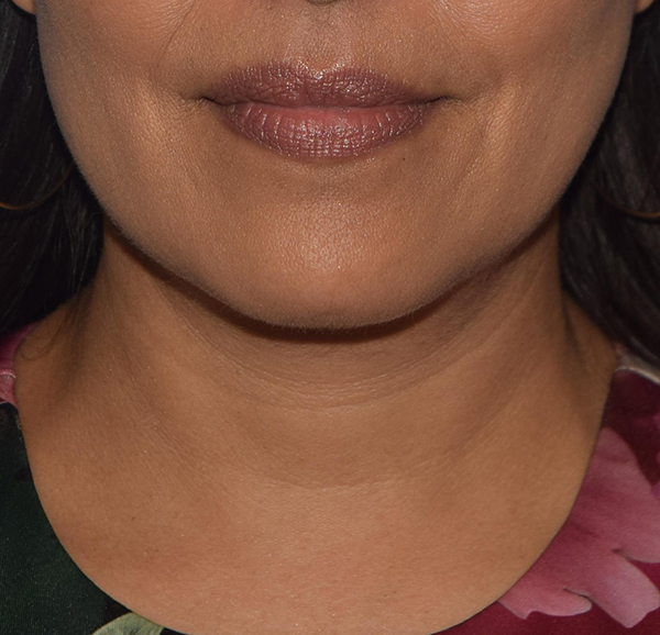 Double Chin Correction Case 1088 After Photo Double Chin Correction