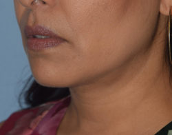 Double Chin Correction