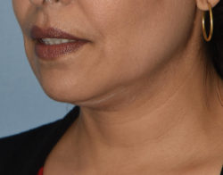 Double Chin Correction