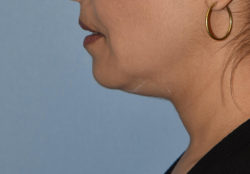 Double Chin Correction