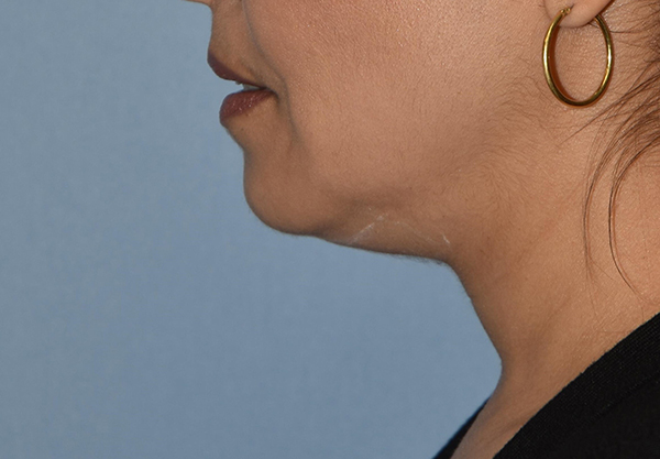 Double Chin Correction Case 1088 Before Photo Double Chin Correction