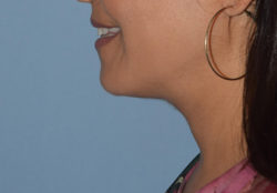 Double Chin Correction