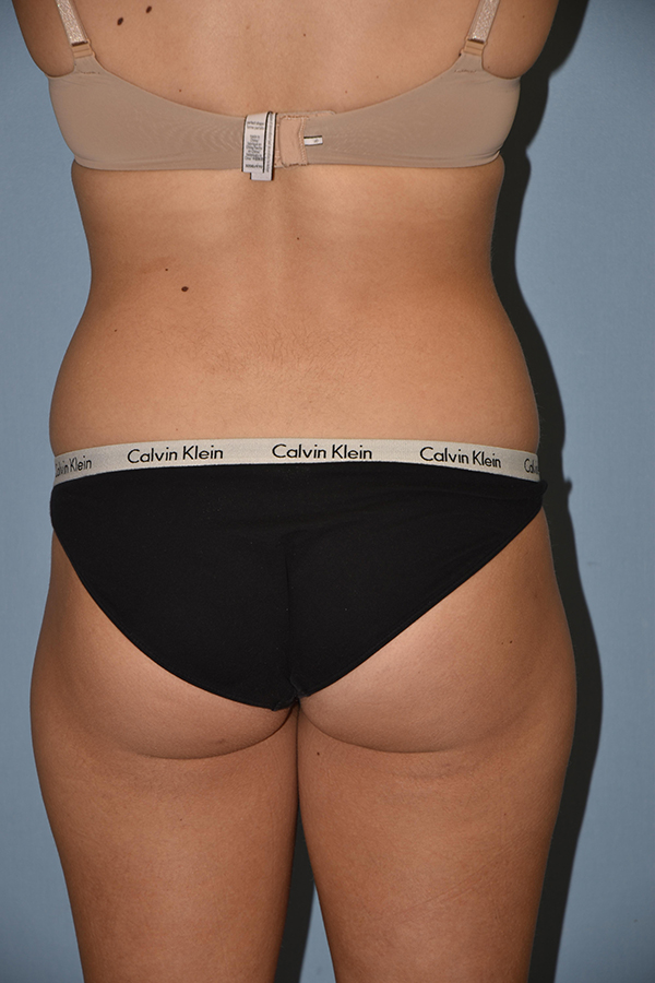 Liposuction