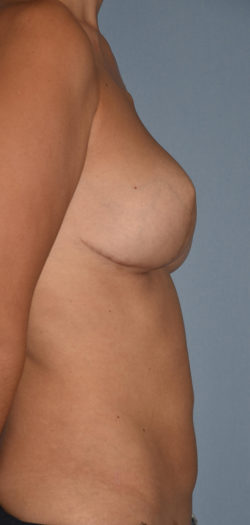 Breast Reconstruction (Implants)