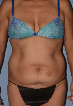 Tummy Tuck