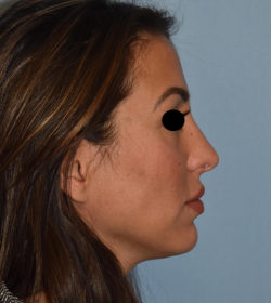 Rhinoplasty