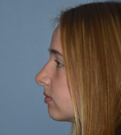 Rhinoplasty