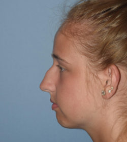 Rhinoplasty