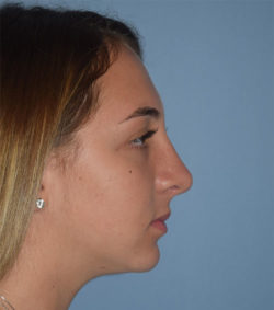 Rhinoplasty