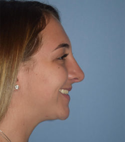 Rhinoplasty