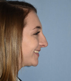 Rhinoplasty