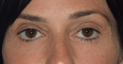 Upper Eyelid Blepharoplasty