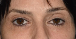 Upper Eyelid Blepharoplasty