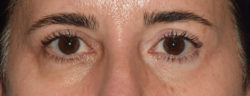 Upper Eyelid Blepharoplasty