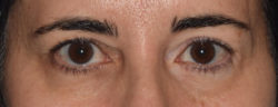 Upper Eyelid Blepharoplasty