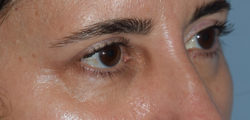 Upper Eyelid Blepharoplasty