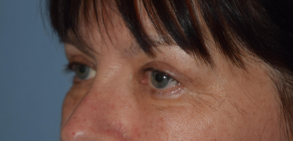Upper Eyelid Blepharoplasty