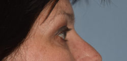 Upper Eyelid Blepharoplasty