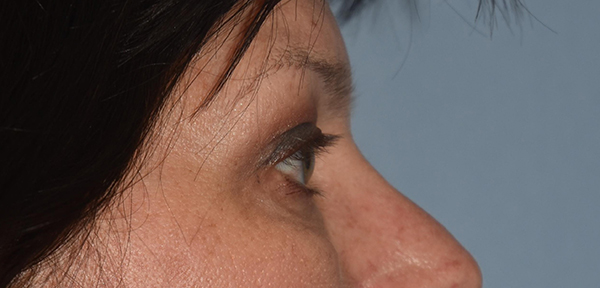 Upper Eyelid Blepharoplasty