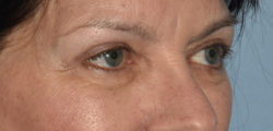 Upper Eyelid Blepharoplasty
