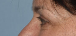 Upper Eyelid Blepharoplasty