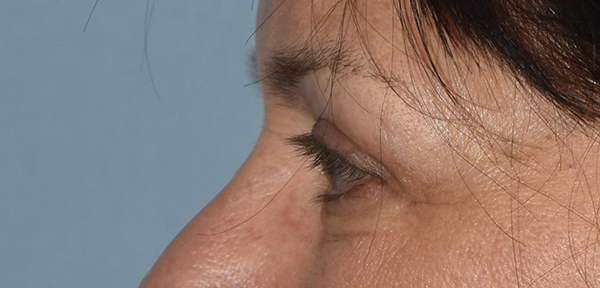 Upper Eyelid Blepharoplasty