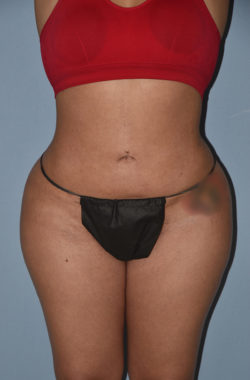 Liposuction