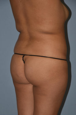 Liposuction