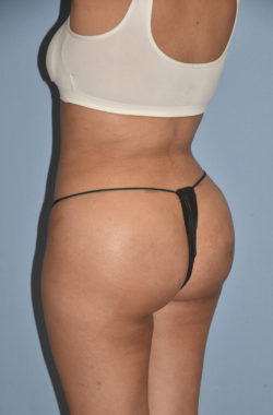 Buttock Augmentation