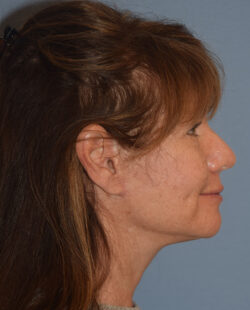 Facelift