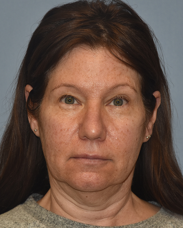Facelift