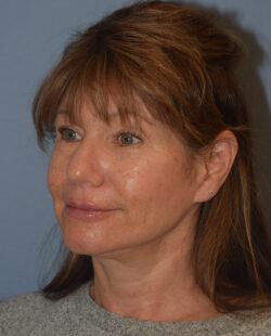Facelift