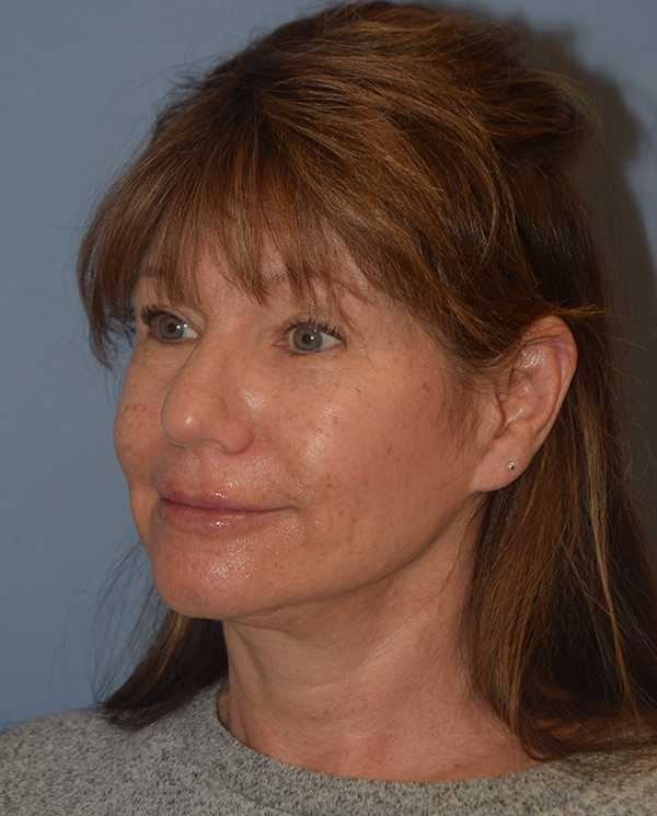 Facelift