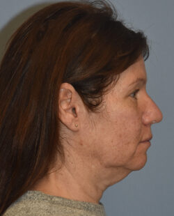Facelift