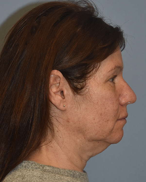 Facelift