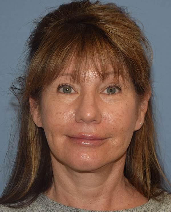 Facelift